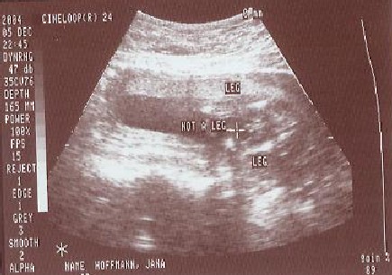 [Image: BabyUltrasoundGender_2004-12-06_001.jpg]